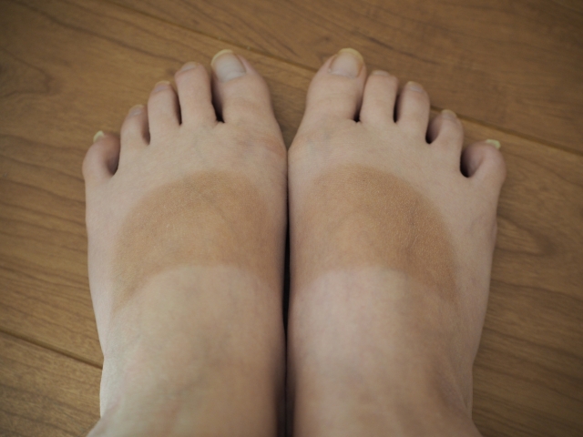 ムラ焼けした足の甲
