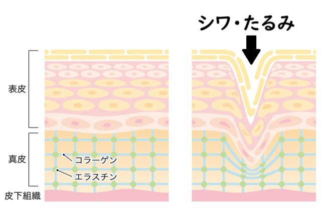 コラーゲンとシワ、たるみ