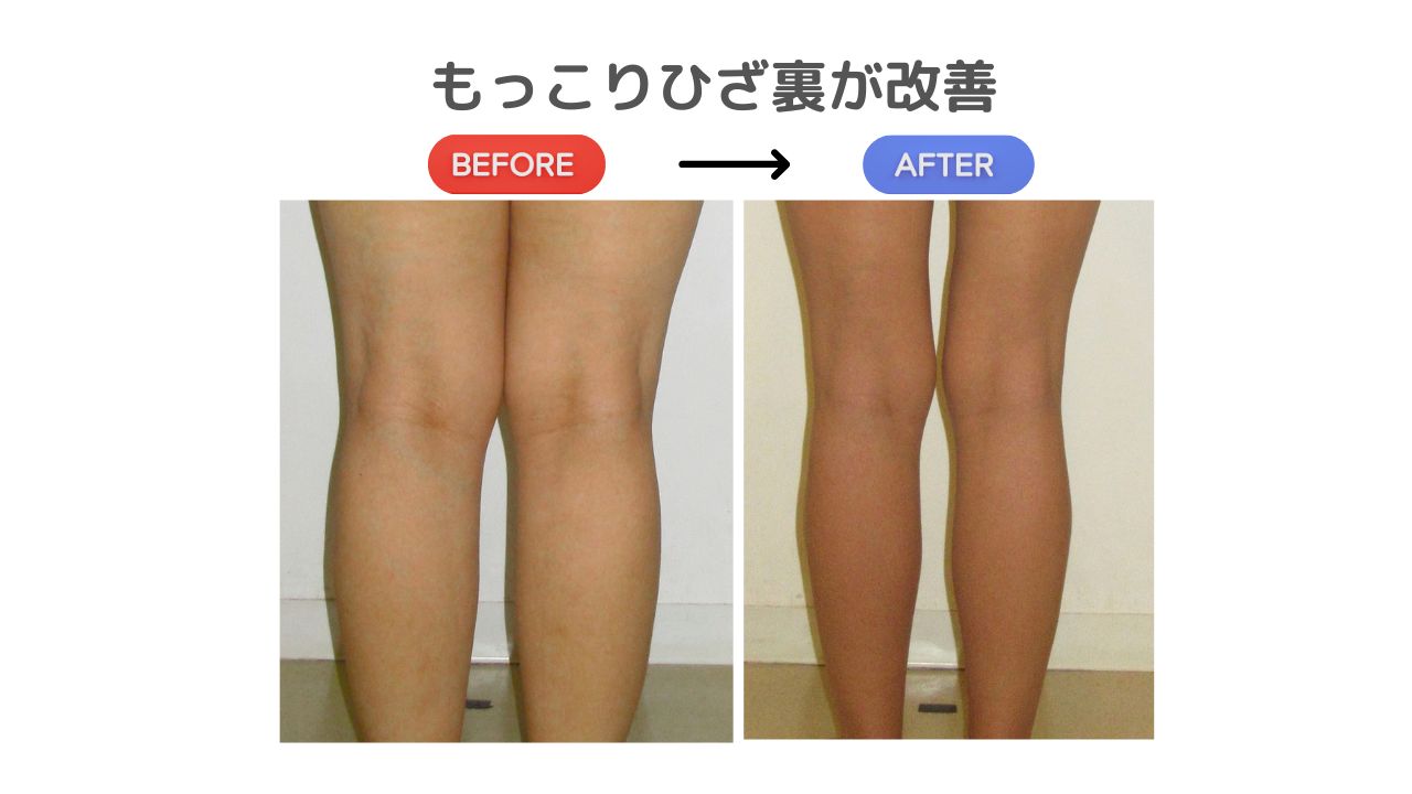 【美脚への道】ひざ裏の“もっこり”が気になる人へ！すっきり見せる簡単ケア